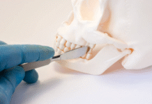 Signs You Need More Than a Simple Tooth Extraction Tooth Extraction